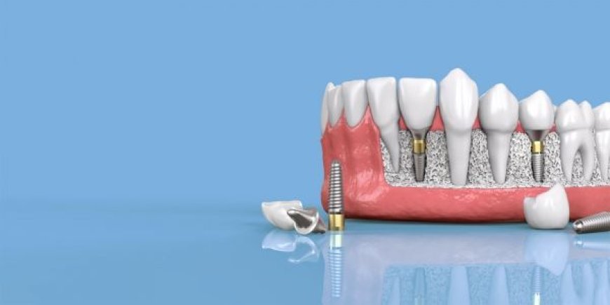 Common Myths and Facts About Dental Implants