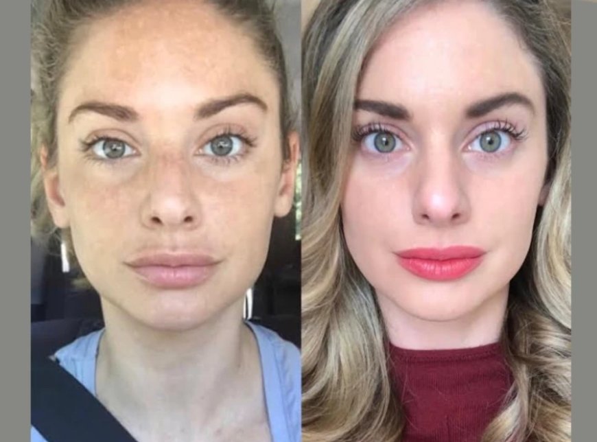 Best Doctors in Dubai for Radiofrequency (RF) Microneedling: What to Expect