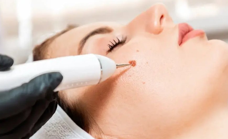 When to choose laser over surgical removal