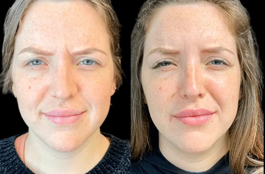 Common Botox Myths Debunked by the Best Aesthetic Clinic in Dubai