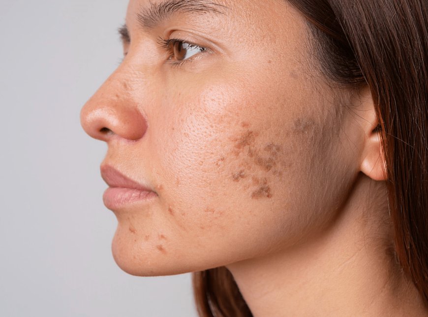How Safe Are Laser Treatments for Pigmentation in Dubai?