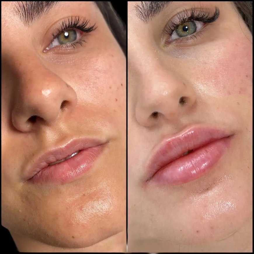 Chin Enhancement with Fillers at Best Plastic Surgeon in dubai