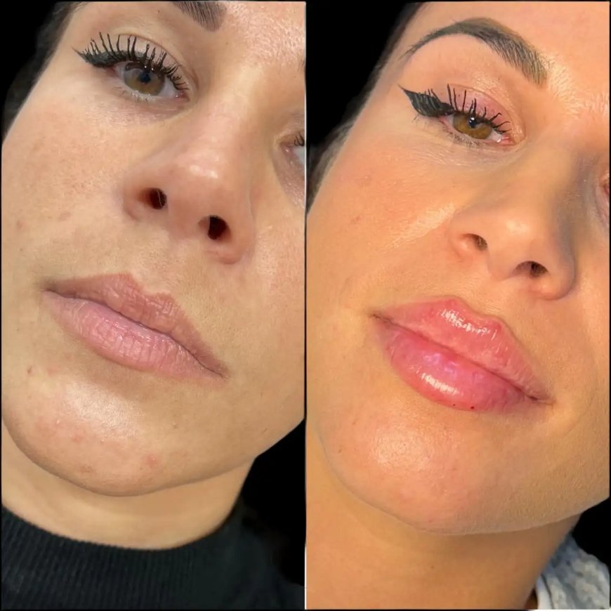Best Aesthetic Clinics in Dubai for Fillers: Advanced Facial Contouring