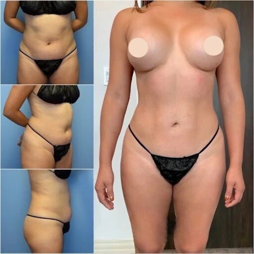 Achieve Your Dream Figure with the Best Body Contouring Surgeon in Dubai
