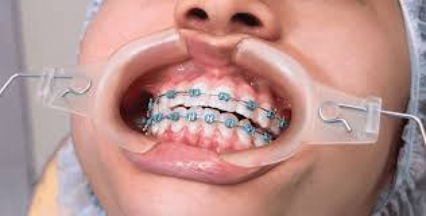 How Braces Improve More Than Just Your Smile