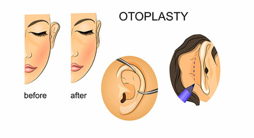 Ear Reshaping Surgery in Delhi - Dr Rajat Gupta