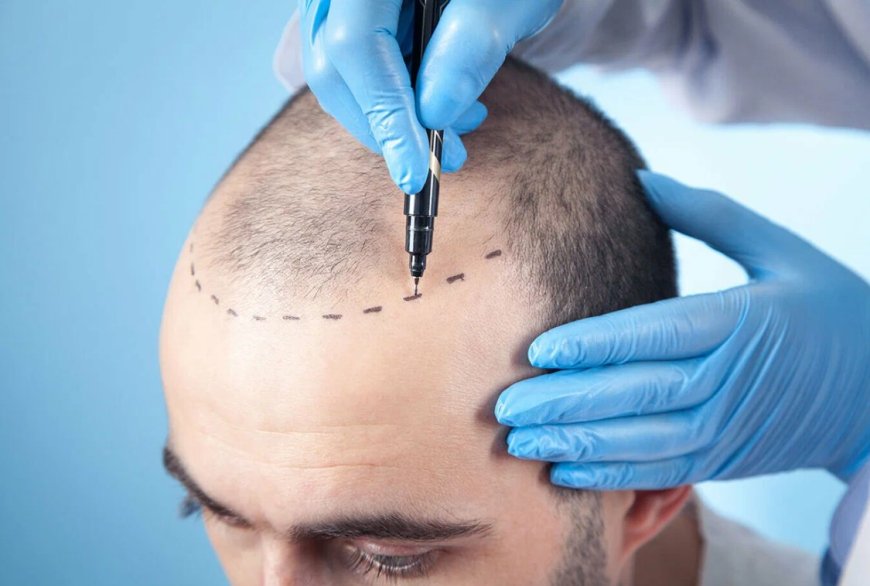 Myths and facts about hair transplant procedures