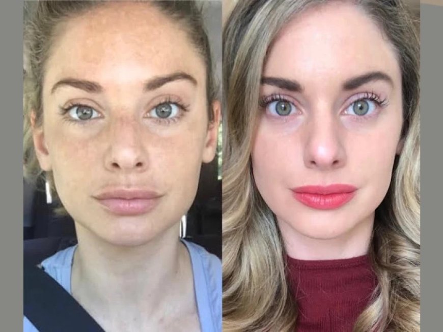 Smooth and Firm Skin with Best Plastic Surgeon in dubai for RF Microneedling