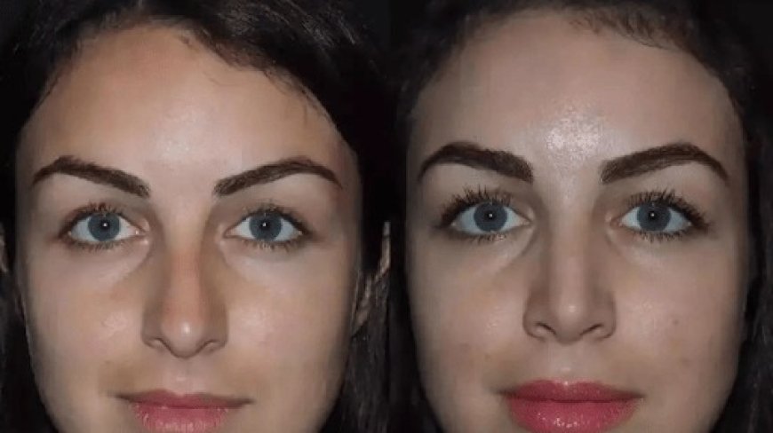 Rhinoplasty in Dubai for Outstanding Cosmetic Results