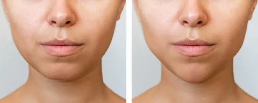 The Role of Bone Sculpting in Facial Harmony
