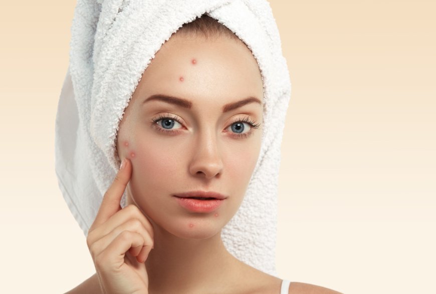 Acne Treatment In Manchester – Advanced Solutions for Clearer, Healthier Skin