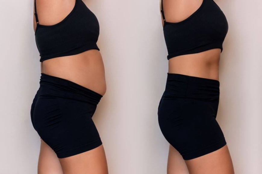 Is Vaser 4D Liposuction the key to refined fat sculpting?