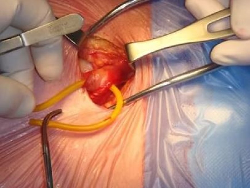Expert Hernia Surgery Singapore: Advanced Treatment for Safe and Effective Recovery