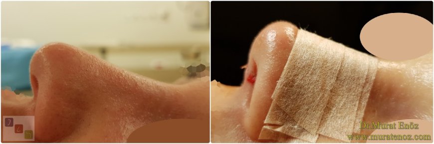 Affordable Excellence: Finding Quality Tip Plasty in Riyadh
