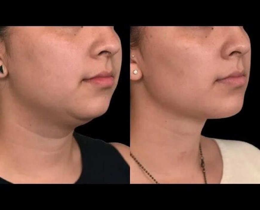 The Evolution of Chin Sculpting: Modern Techniques Available in Riyadh