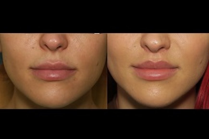Lip Lift Surgery: A Surgical Approach to Youthful, Fuller Lips in Riyadh