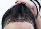 زراعة الشعر للنساء في بريدة