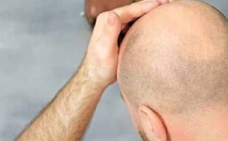 Is Hair Transplant Permanent?