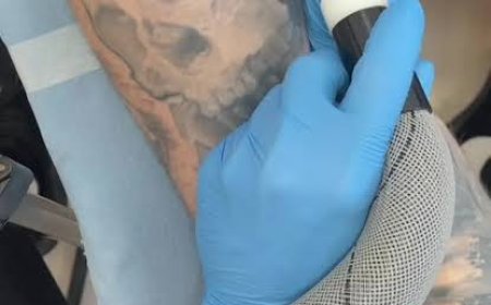 Tattoo removal for professional or workplace reasons