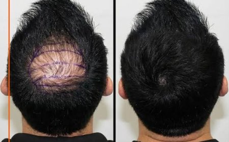 Hair transplant for genetic baldness patterns