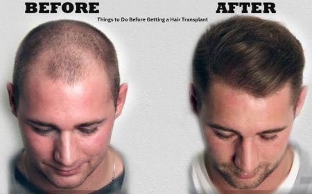 How to prepare mentally for a hair transplant procedure