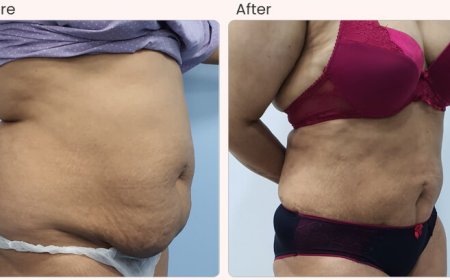 Liposuction Surgery in Delhi - Dr Rajat Gupta