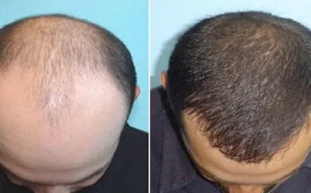 1 Dirham Hair Transplant in Dubai: Hair Loss Relief
