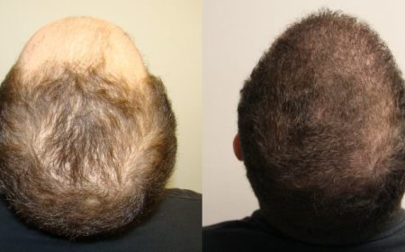 Hair Transplant in Sharjah: Precision Growth Methods