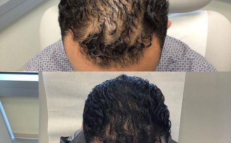 Scarless Hair Transplant in Dubai: Natural Growth Redefined