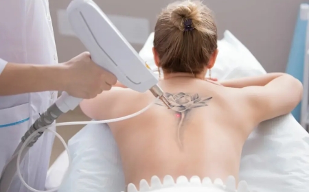 Tattoo removal in Riyadh Latest Laser Technologies Explained