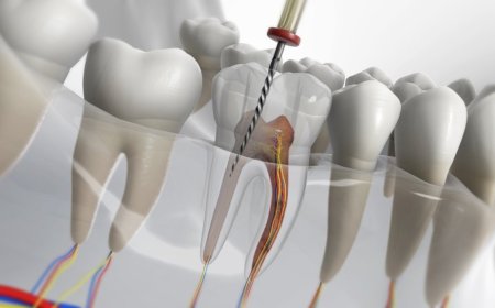 Key Factors Influencing Root Canal Treatment Cost in Parel Mumbai You Should Know