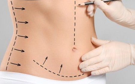 Tummy Tuck in Dubai: Addressing Excess Skin and Muscle Laxity