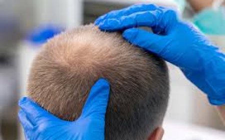 كل ما يجب معرفته عن زراعة الشعر في الدمام