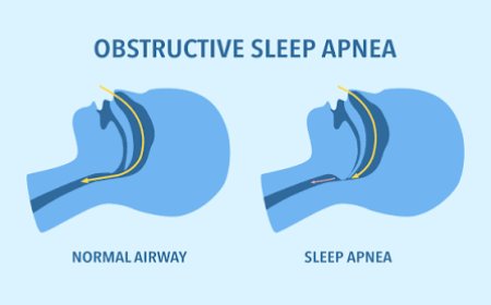 Sleep Apnea Implants Market Growth Driven by Rising Prevalence of Obstructive Sleep Apnea Worldwide