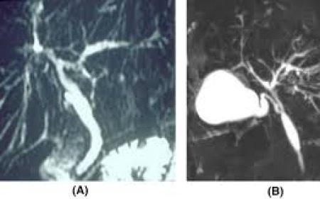 Primary Sclerosing Cholangitis Market Growth Driven by Increasing Research in Rare Liver Disease Treatments