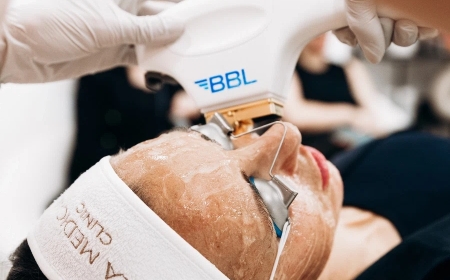 BBL Laser in Manchester: Advanced Light Therapy for Brighter, Clearer Skin