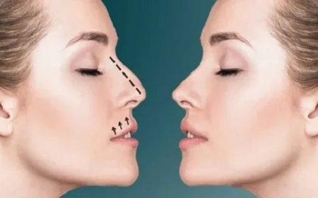 Rhinoplasty in Dubai: Expert Guide to Nasal Refinement
