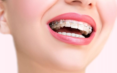 Braces Treatment in Tirupati: A Simple Guide for Pilgrims and Local Residents