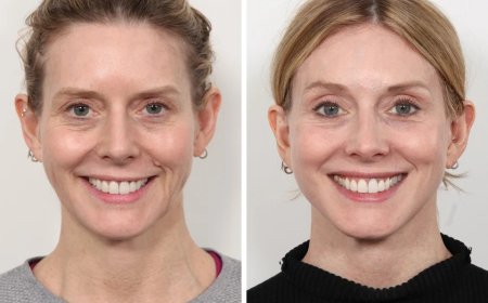 Best Plastic Surgeon in Dubai Explains Facial Lifting Without Surgery