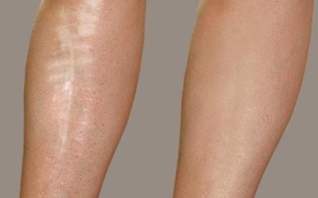 Post Surgical Scar Treatment in Dubai: Superior Skin Care
