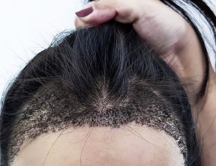 زراعة الشعر للنساء في بريدة