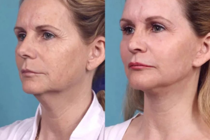 Is Chemical Peel Treatment in Dubai Effective for Dark Spots?