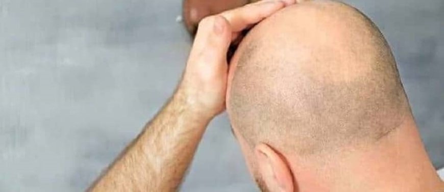 Is Hair Transplant Permanent?