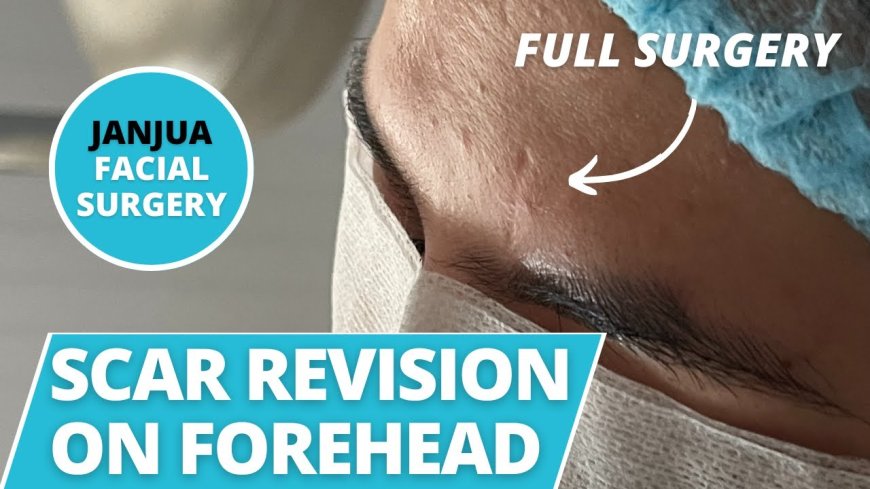 Understanding Scar Revision: Restoring Your Skin’s Natural Texture