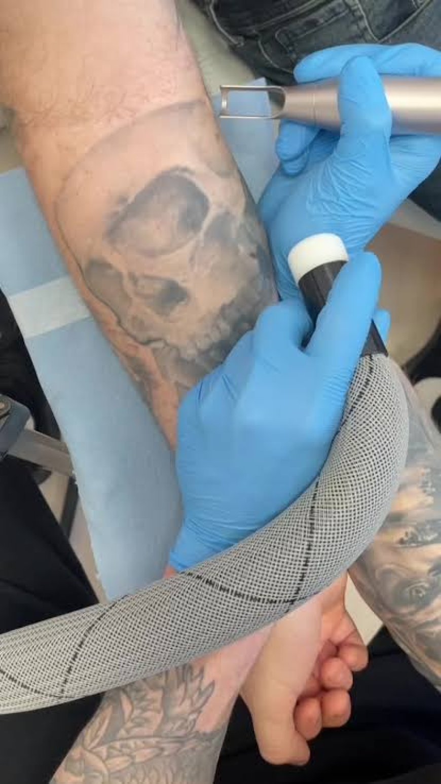 Tattoo removal for professional or workplace reasons