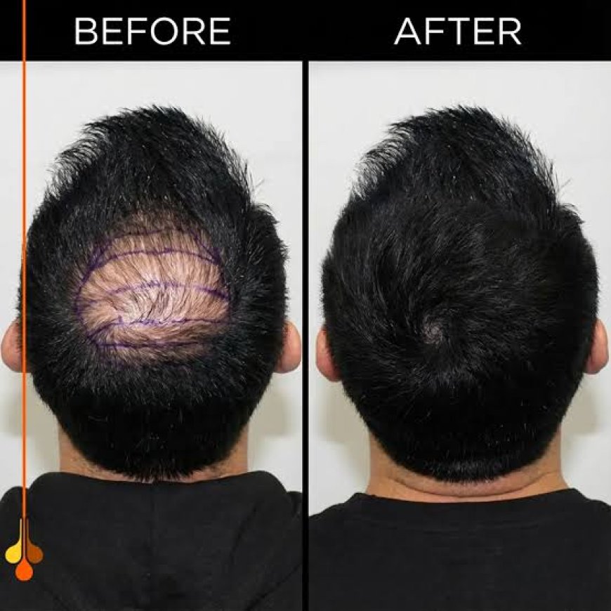 Hair transplant for genetic baldness patterns