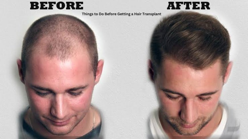 How to prepare mentally for a hair transplant procedure