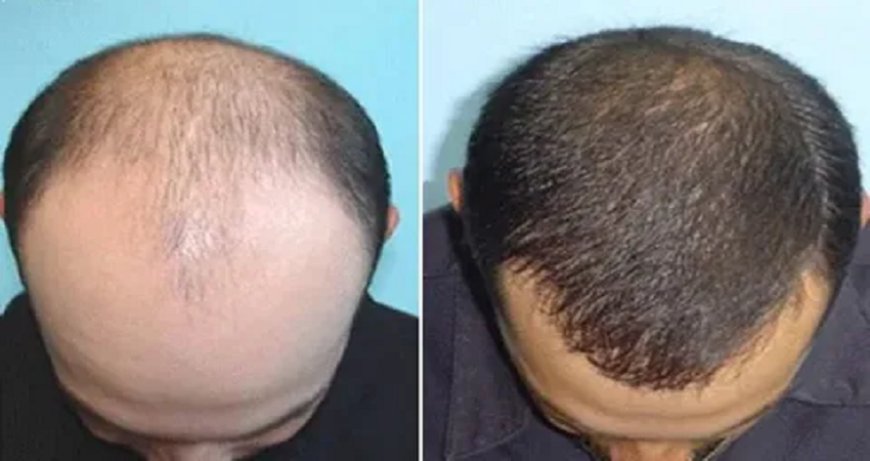 1 Dirham Hair Transplant in Dubai: Hair Loss Relief