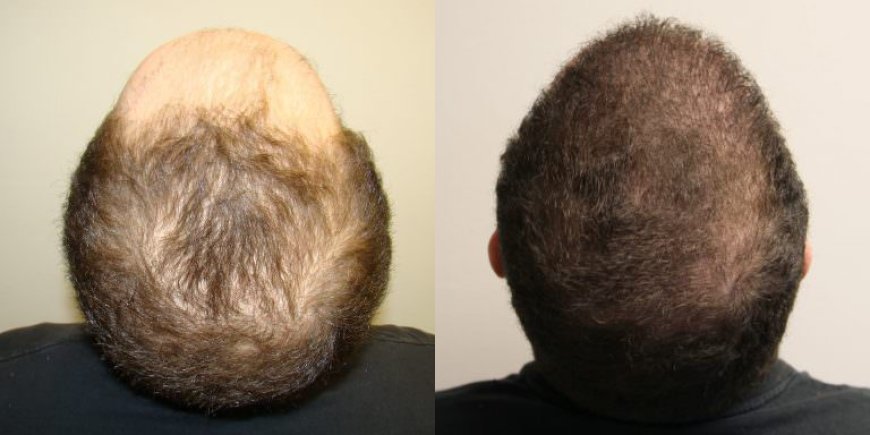 Hair Transplant in Sharjah: Precision Growth Methods