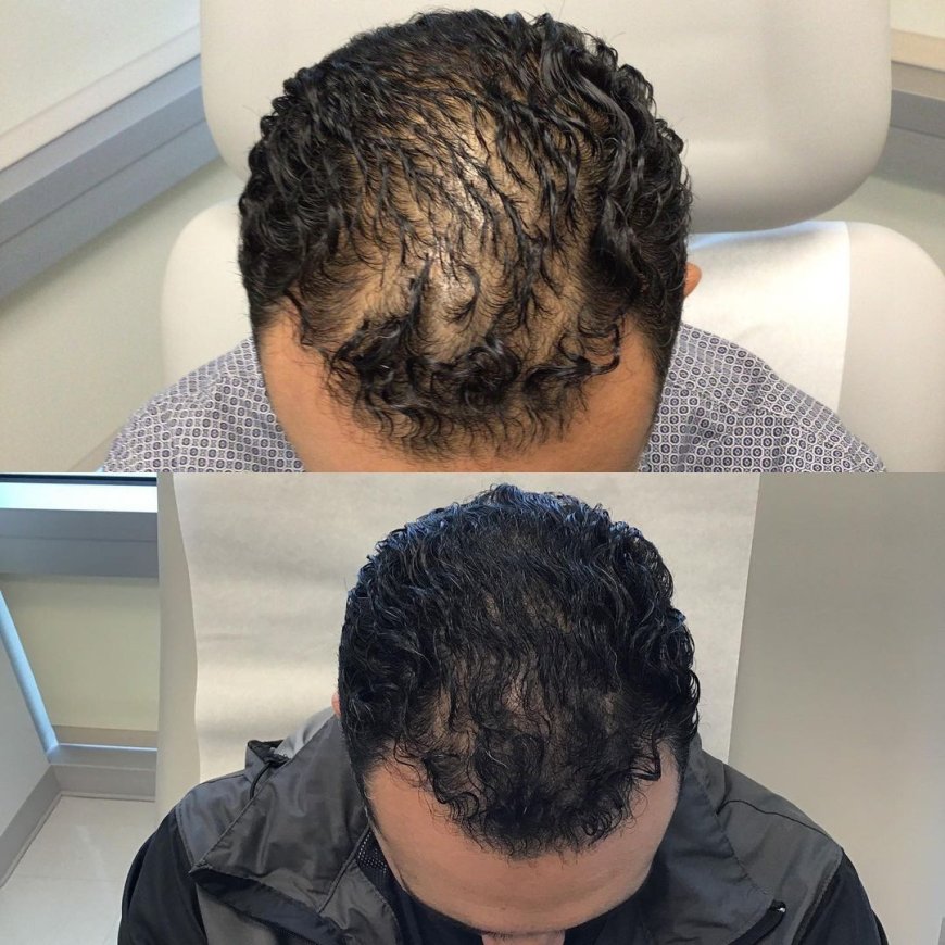 Scarless Hair Transplant in Dubai: Natural Growth Redefined